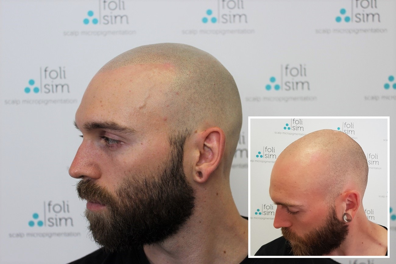Find out how popular scalp micropigmentation north London